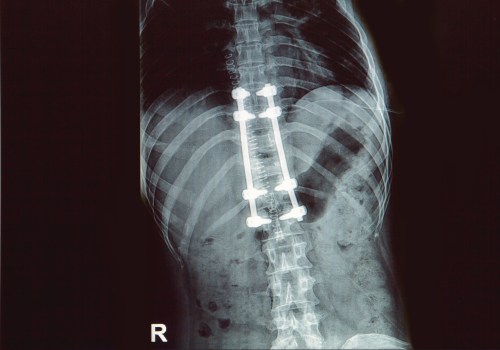 How much is a lumbar fusion worth?